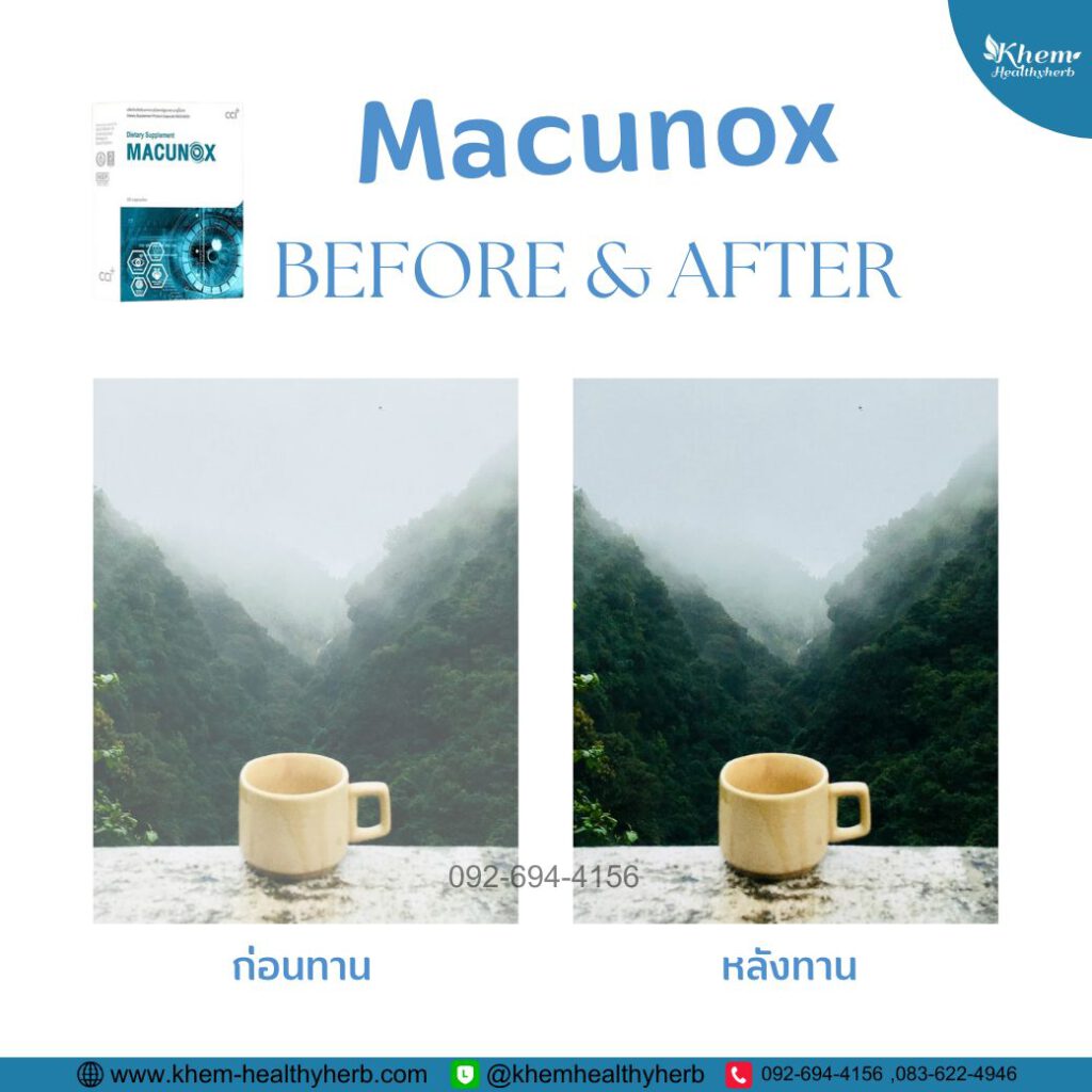 มาคูน็อกซ์ -Macunox-โรคต้อ